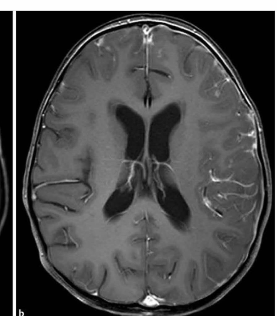 Abdulaziz Almubarak on Twitter "DDx of leptomeningeal enhancement meningitis, carcinomatosis