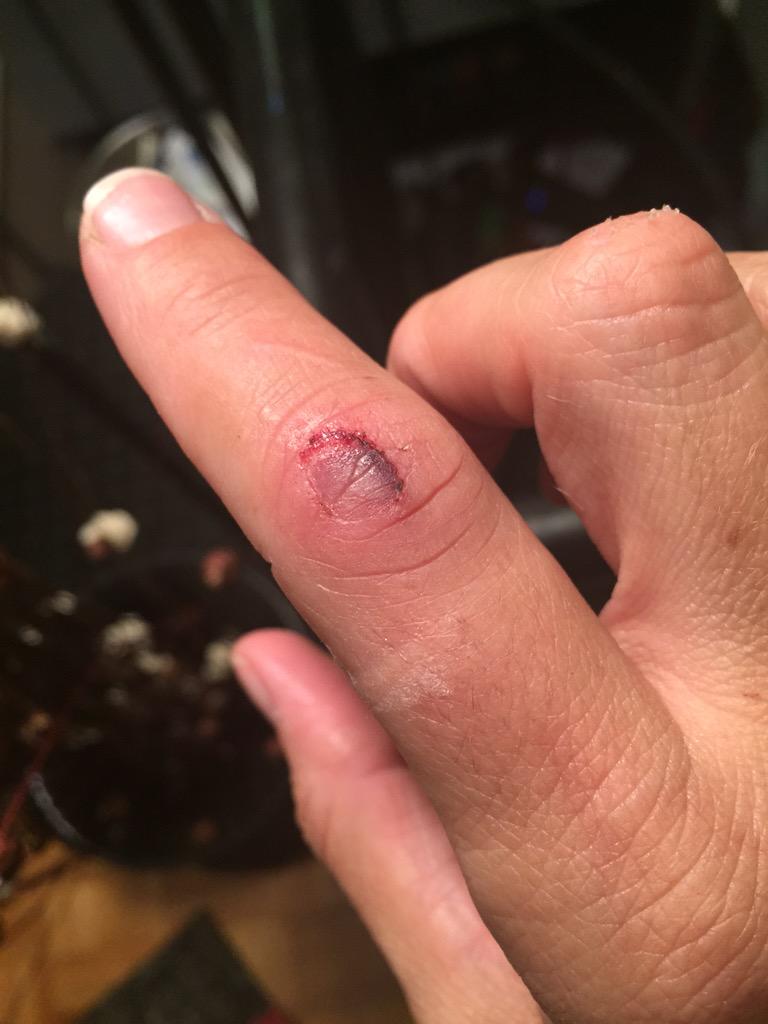 Jen_Royle's tweet image. Can&apos;t bend my finger any more than this. Have no idea when I can get a boxing glove on. 😫