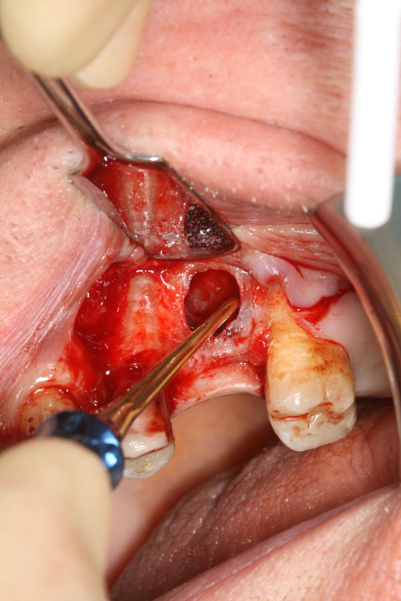 AlbertPlace's tweet photo. Take extreme care to prevent tearing #Botiss #sinusgraft @DrRobCarson @StraumannUK @implantcourses @ChelsStraumann http://t.co/PdxzmIz2wx