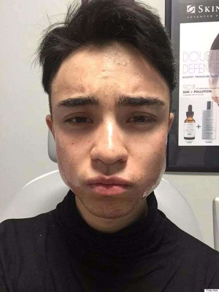 diolaserflorida's tweet photo. Check out this news reporter from @thehuffpost_ #vampirefacial experience: http://t.co/xKUWs3taHK #PRP http://t.co/Cx5VxPPxs9