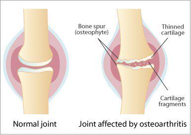 kneejointcare's tweet photo. Physical examination &amp; x-rays r used to diagnose knee #Osteoarthritis
#Knee_Joint_Replacement 
http://t.co/sCiQGSJeyo http://t.co/CgCgW6cO0m