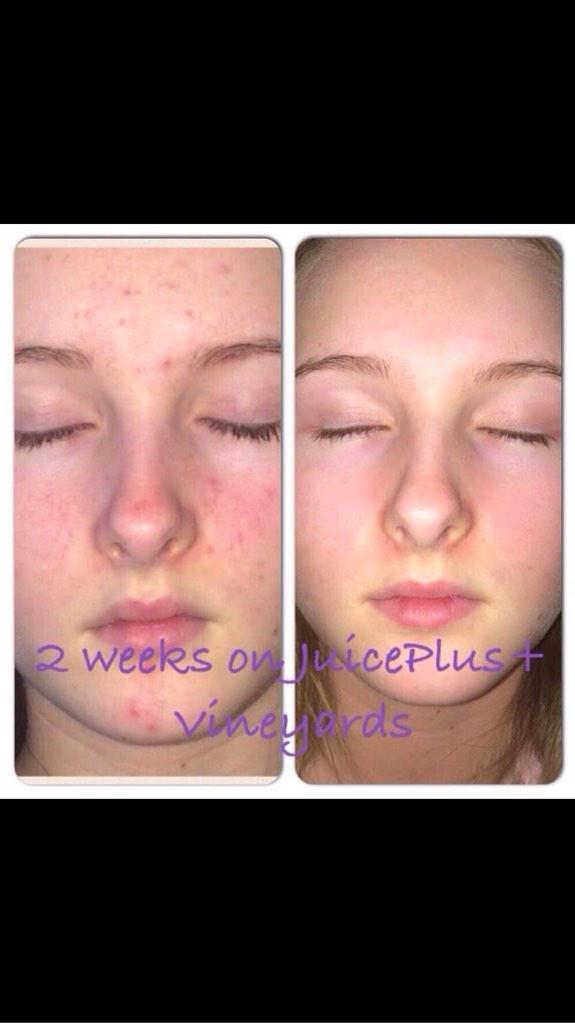 shapeupdiary's tweet image. Results from our capsules👌 what an improvement🙌 looking good and full of confidence🍇🍉🍓✨