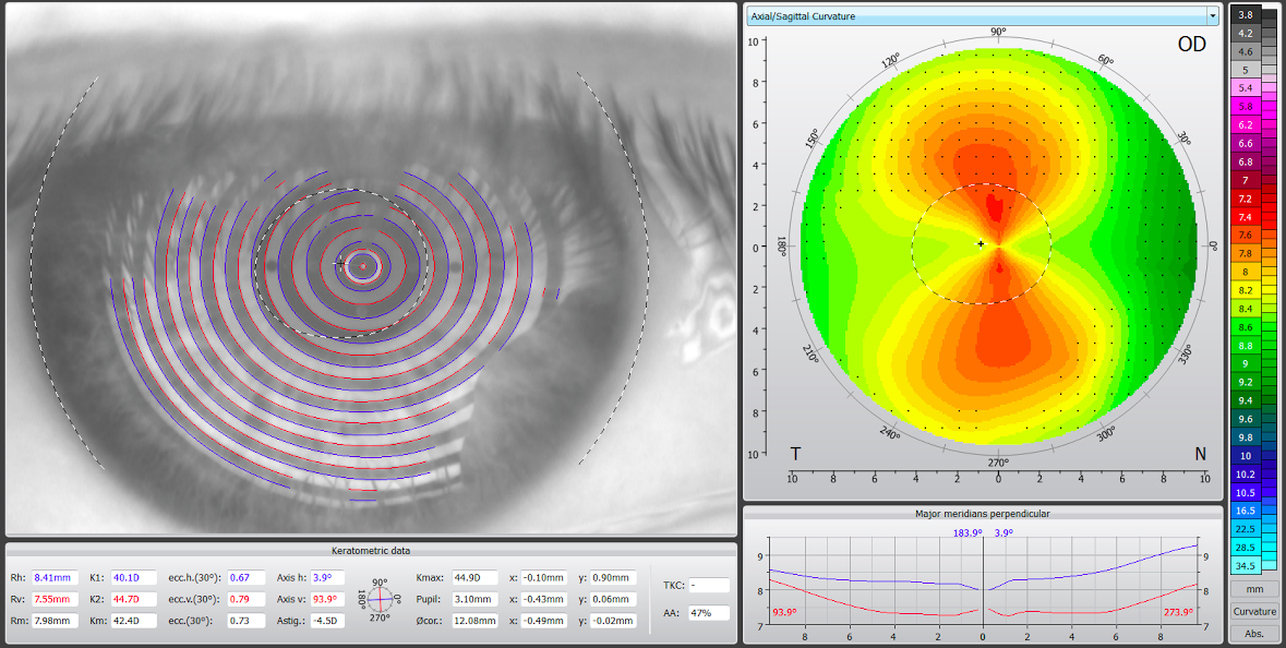 SmartOptometry's tweet photo. High astigmatism, what kind of lens would you go for? Its definitely RGP! #grp #lensfitting #optometry #astigmatism http://t.co/HhLUjiKena