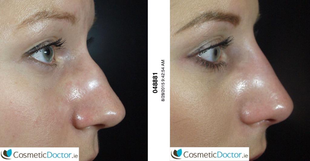 DRLISAFAY's tweet image. RT Thank you @drRaspaldo: Non-surgical rhinoplasty tips from Dr. Raspaldo. Happy client!!