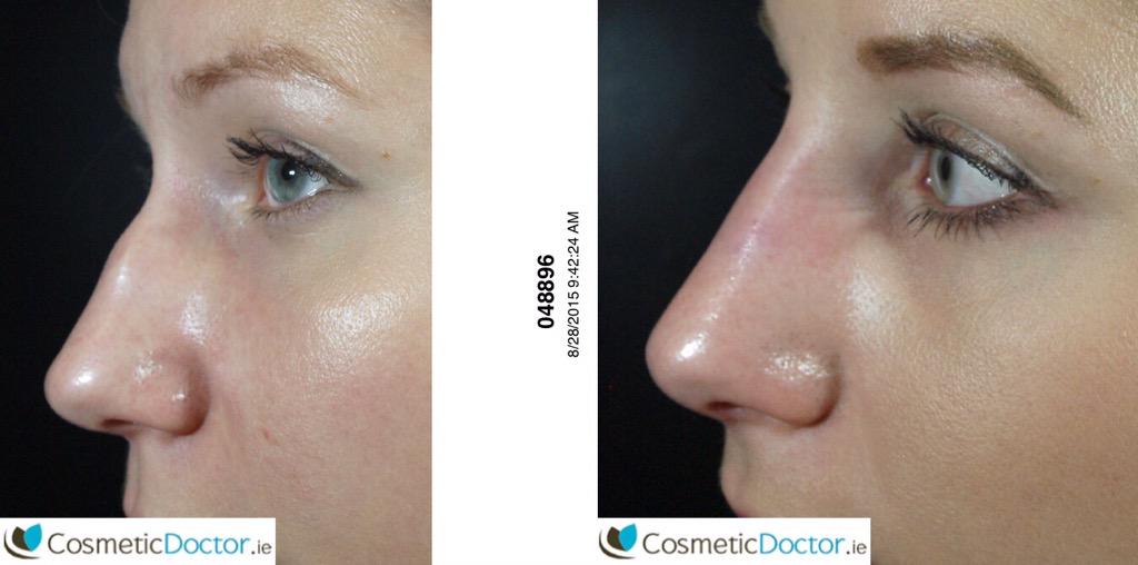 DRLISAFAY's tweet image. RT Thank you @drRaspaldo: Non-surgical rhinoplasty tips from Dr. Raspaldo. Happy client!!
