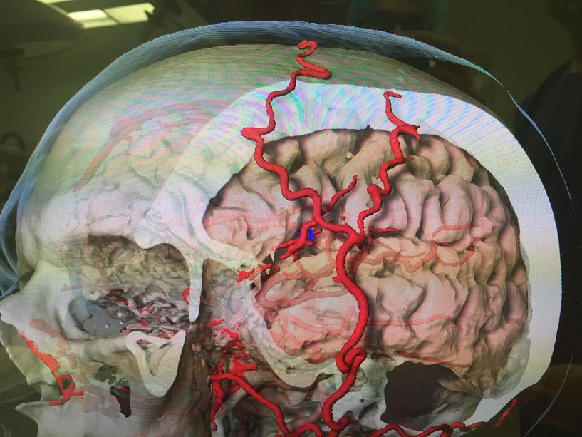 Parkville_Neuro's tweet photo. Advanced 3D vascular navigation means we can do procedures not possible before #neurosurgery http://t.co/qe7iD754HM