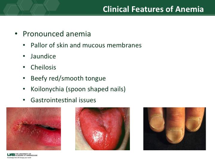 Smooth Tongue Anemia