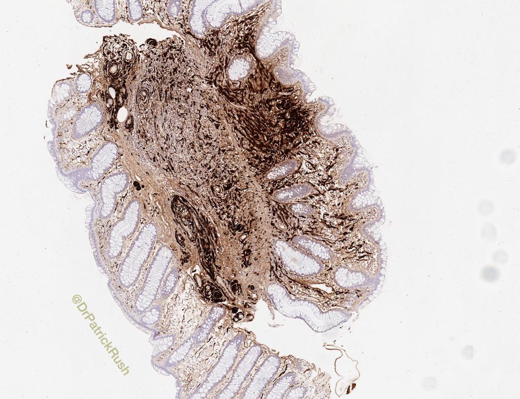 Mucosal SchwannCell hamartoma:Schwann cell prolif. In the lamina propria that entraps colonic crypts S100+ #pathology