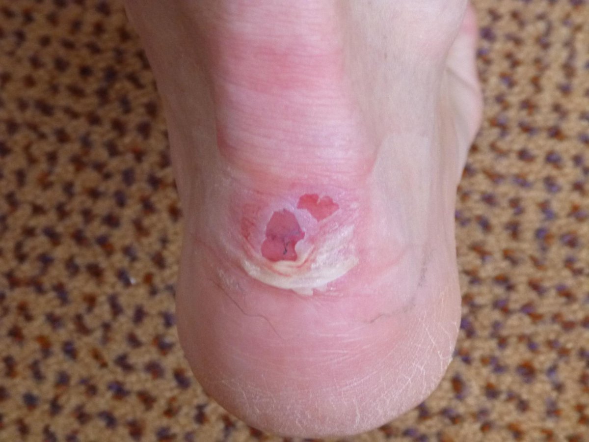 Team_LungCancer's tweet image. Is this a blister contest @onewalkwarrior ? RT this #OneWalkShoeSelfie for @Team_LungCancer. @ShopprsDrugMart @TELUS