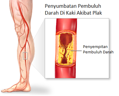 Penyumbatan pembuluh darah di kaki