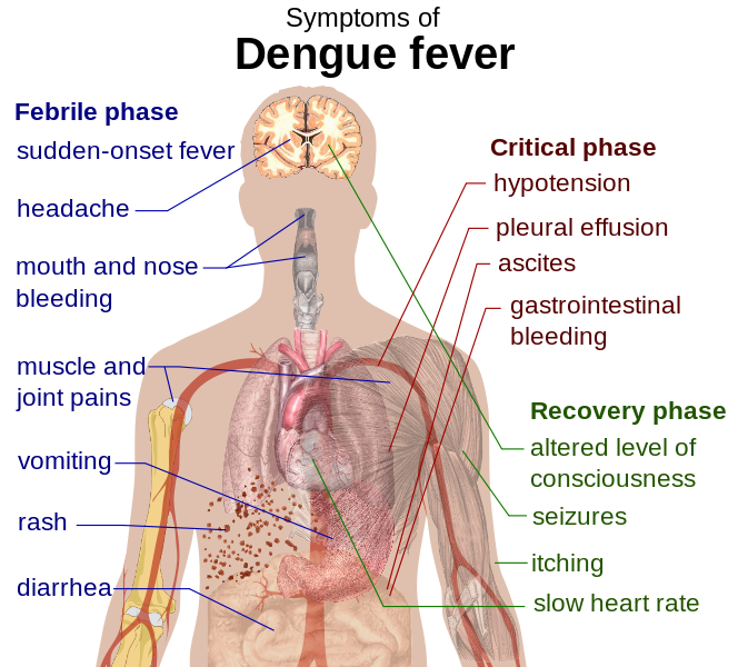 Denguefeber