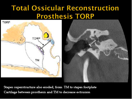 JennyKHoang's tweet photo. #Radres do you suffer from PORP-TORP confusion? All you need to know fm @gmoonis #temporalbones #ASHNR15 #Neurorad http://t.co/eBQneBmlLq