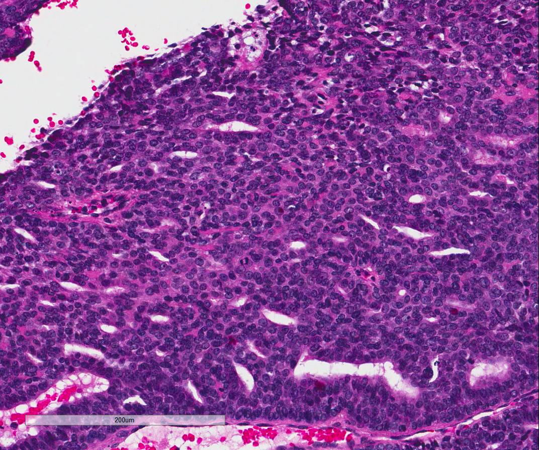 Digital papillary carcinoma, male, 25 years old, big toe #dermpath #dermatology #histology #pathology