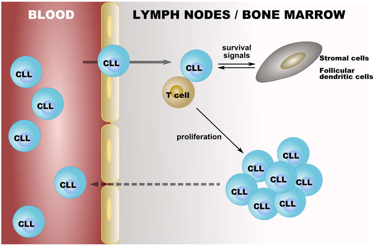 BloodLymph's tweet photo. Chronic #Lymphocytic #Leukemia
http://t.co/7NvewneYt7 http://t.co/7A0kLfD62n