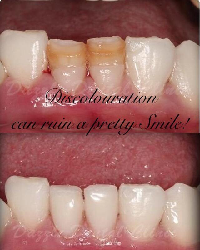 dazzledentists's tweet photo. Intrinsic stains corrected using Composite Laminates (Bonding) at Dazzle. #dazzledental #cosmetic #dentist #mumbai http://t.co/2PPXEzHqbM