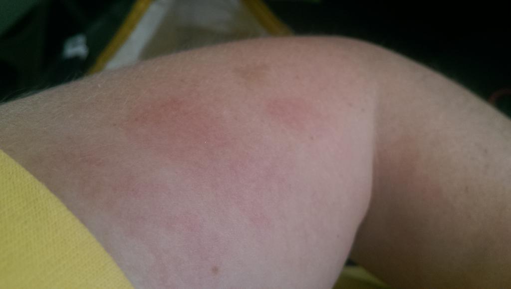 tea_n_toasted's tweet image. Woke up from bad dreams clenching my own arm so hard my fist hurts and I left marks #signsofstress #travelpics