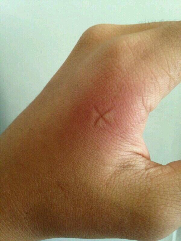 StumblerTop's tweet photo. who else did this when you got a mosquito bite http://t.co/vOyGWqQsFg