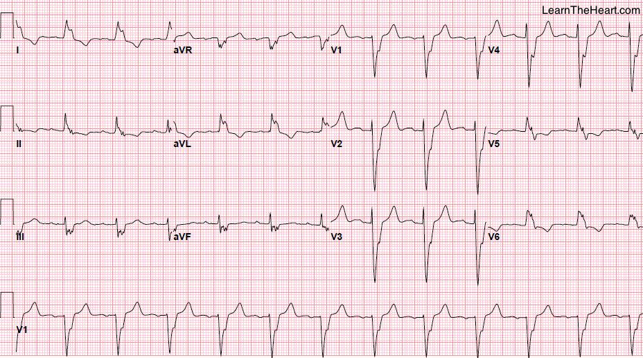 LearntheHeart's tweet photo. Cabrera's sign ➡ Acute MI can be seen on #ECG with LBBB ➡ notch at 40 ms in upslope of S wave in lead V3/V4 #USMLE http://t.co/Odvqa7HUWi