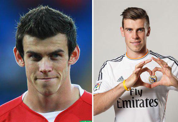 Dr. Julio Puig on X: "El futbolista Gareth Bale antes y después de la  #otoplastia : http://t.co/KTvwSr5Lzr @TheLuxonomist http://t.co/4T3vYBJno2"  / X