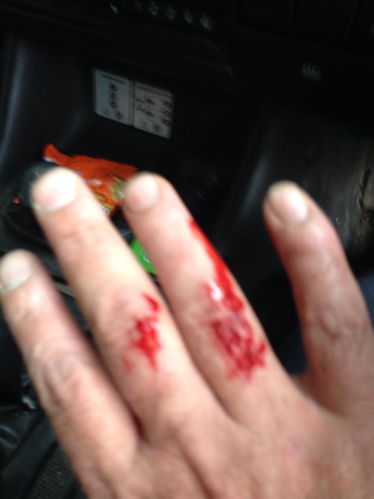 carl1shoot's tweet photo. Bloody wire mesh where the #accidentbook #shootcaptain @JasonYoung448 don't bother I can't write with no fingers http://t.co/xH3ksrGVjN