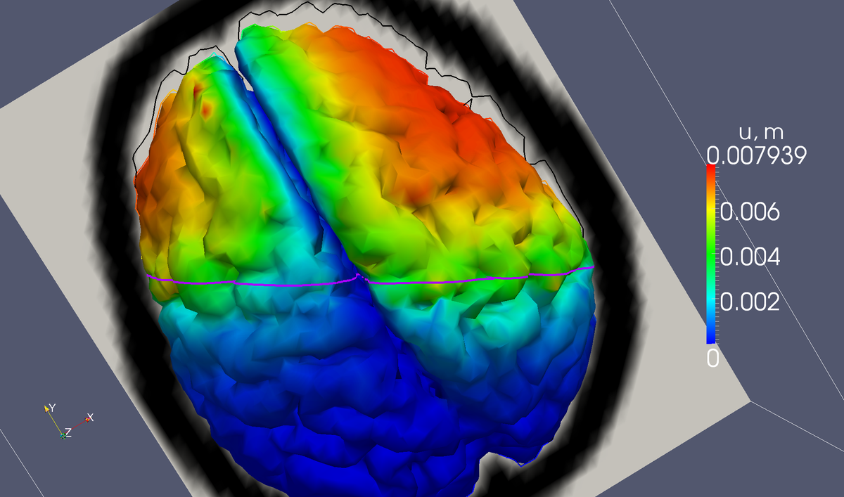 AvtechSci's tweet image. #OpenCL based ASL assists neurosurgeons/rob-s,computes brainshift inRealTime.@thekhronosgroup ow.ly/RWqJq