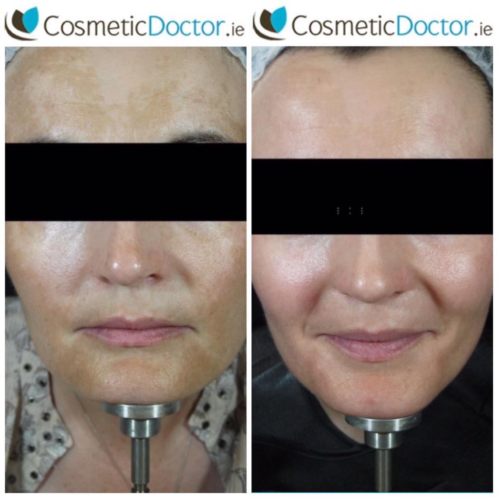DRLISAFAY's tweet image. &quot;Transformation Tuesday&quot;: improvement in pigmentation using ZO Skin Health by Zein Obagi, MD Skincare. #melasma