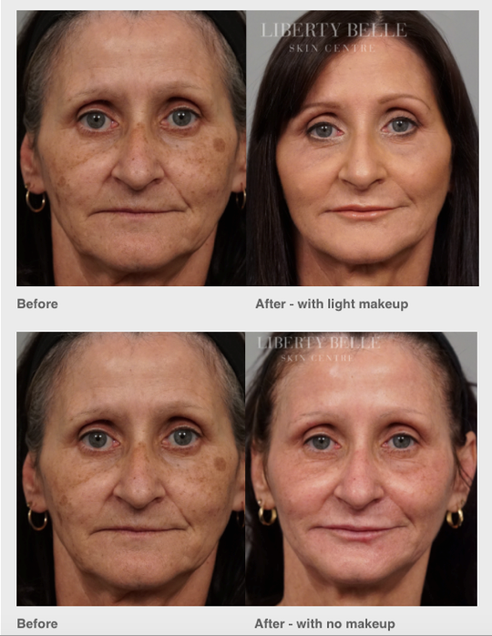 LibertyBelleAUS's tweet photo. Meet Barb! A chance meeting with @MrsAndreaMoss resulted in this non-surgical transformation https://t.co/GI81Ydd9qm http://t.co/jr0j2nV3He