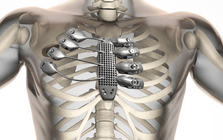 gizmag's tweet image. Patient receives 3D-printed titanium sternum and rib cage - gizm.ag/1ii4yj0