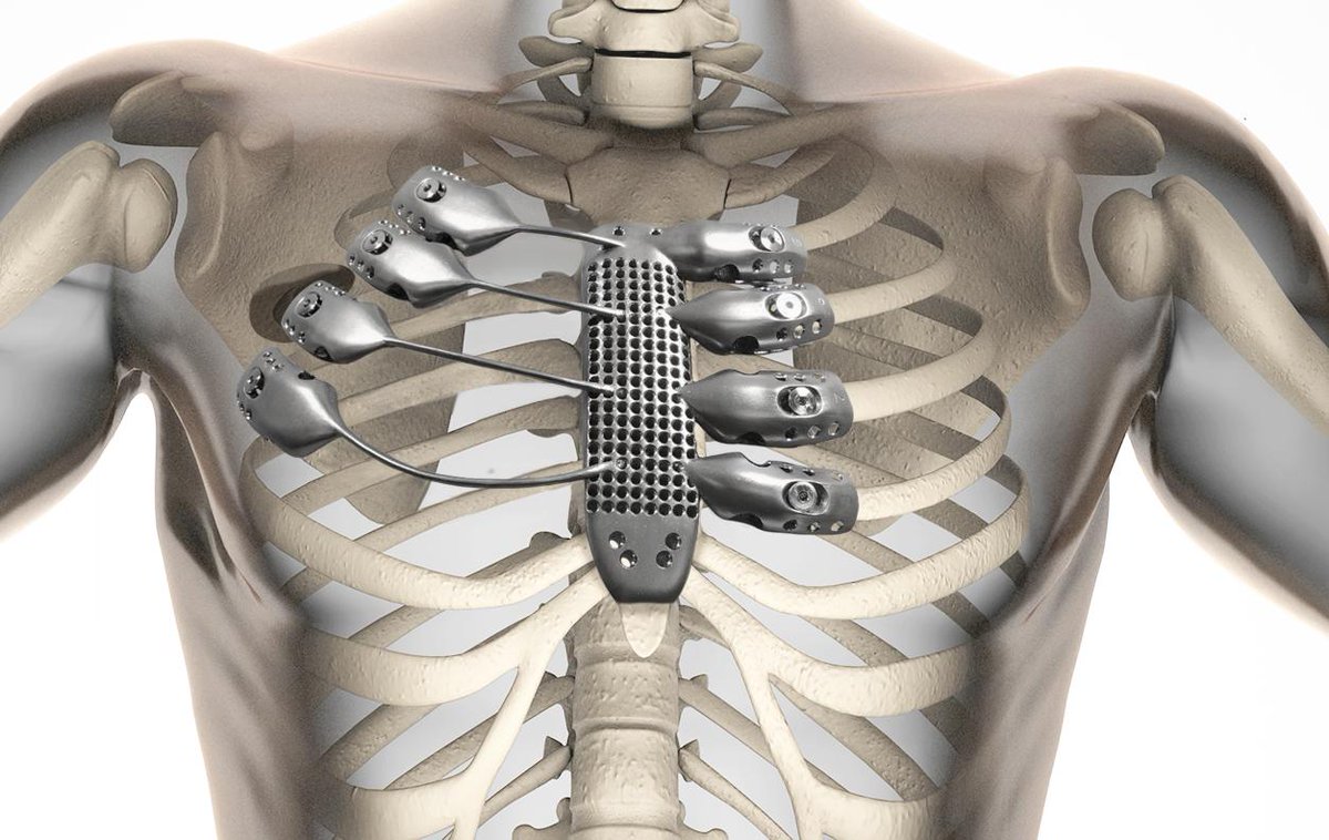 Engadget Spanish Cancer Patient Gets A 3d Printed Titanium Rib Cage Http T Co Sropfee7sx Http T Co lpnprdai
