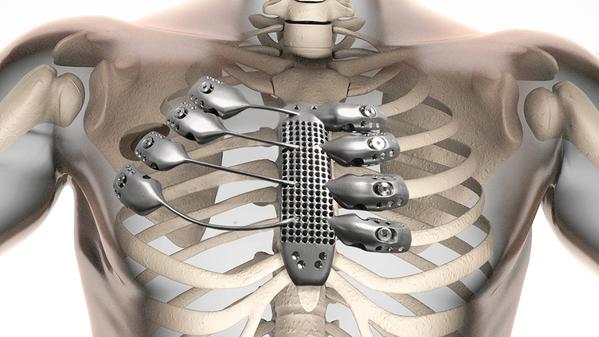 PCH_Intl's tweet photo. The world's first 3D-printed titanium rib cage is a medical marvel http://t.co/4ht3Iq6r1F  @via @Gizmodo http://t.co/CLPHZCKBUj