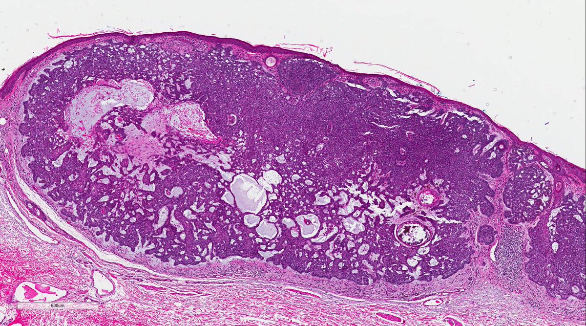 Paul Drury On Twitter Nodulocystic Basal Cell Carcinoma M68