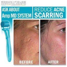 Klhiggins1's tweet photo. Have #acne #scarring? I have a tool that can help ask me how!!! http://t.co/On1MKpL84M
