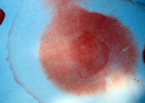 KishoreSR's tweet photo. Halo sign! Seen in case of a RTA induced CSF Rhinorrhea! #ENT #Halosign http://t.co/Ml1hX03Lal