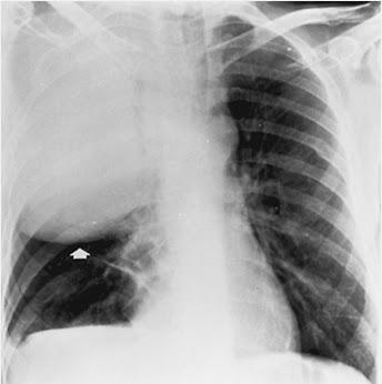 Bulging Fissure Sign