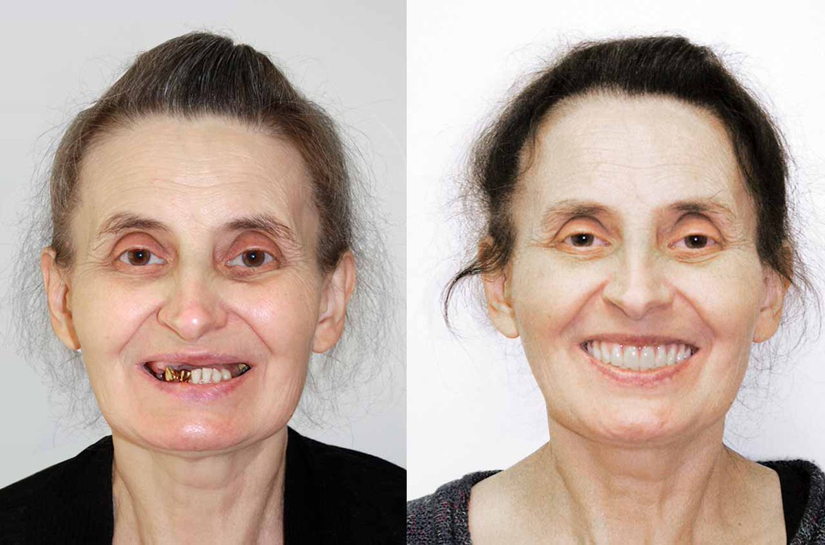 #Dental #Implants - #Implant #technology is giving #people full #confidence to #smile again. drantipov.com/dental-implants