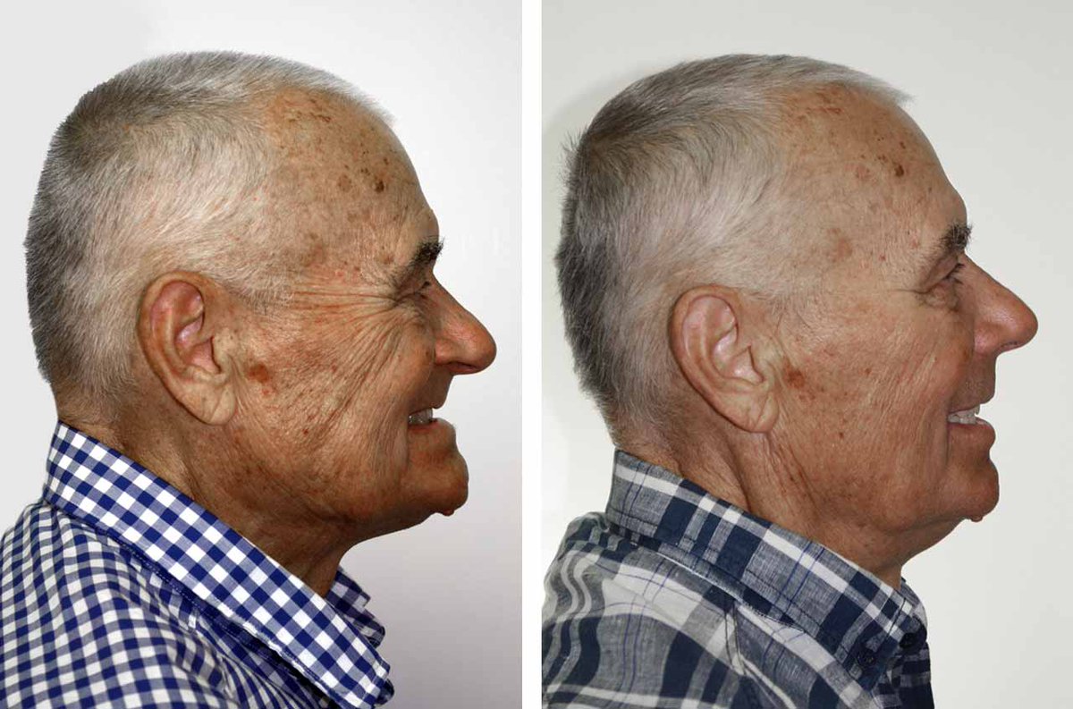 #Multiple #Implants - <a href="/Dr_Antipov/">Dr.Alexander Antipov</a> is a leading #specialist in #procedures requiring two or more implants at one time.