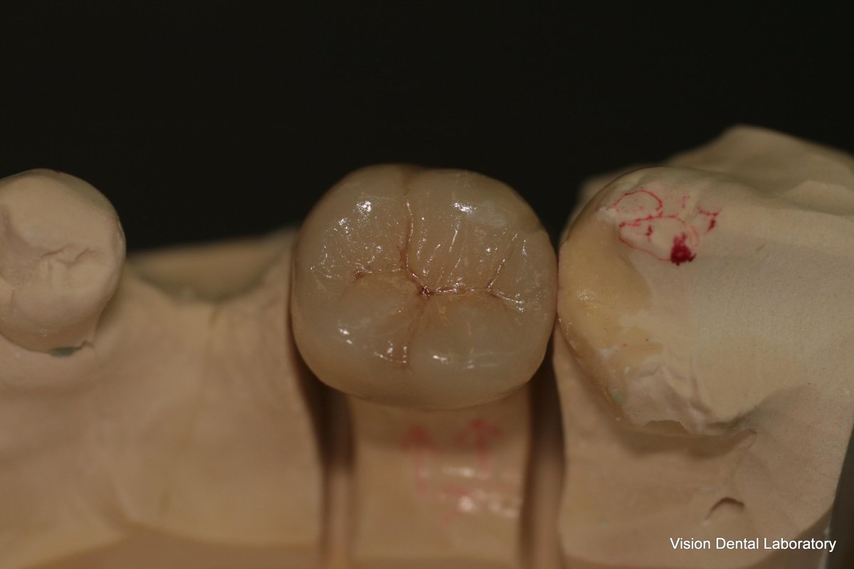 visiondentalab's tweet photo. E-max Crown http://t.co/rr33RqmAqP