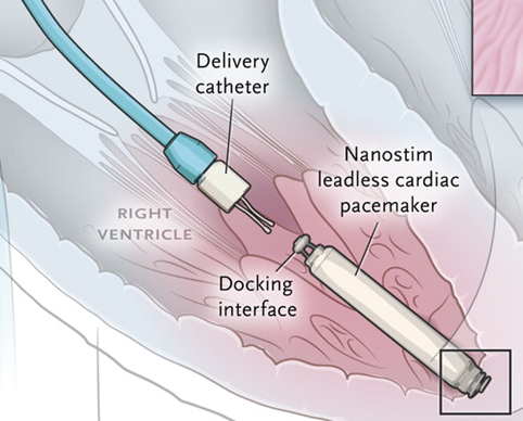 NEJM's tweet photo. Original Article: Percutaneous Implantation of an Entirely Intracardiac Leadless Pacemaker. http://t.co/PlpxdMFyUO http://t.co/0TmGVwrKq3