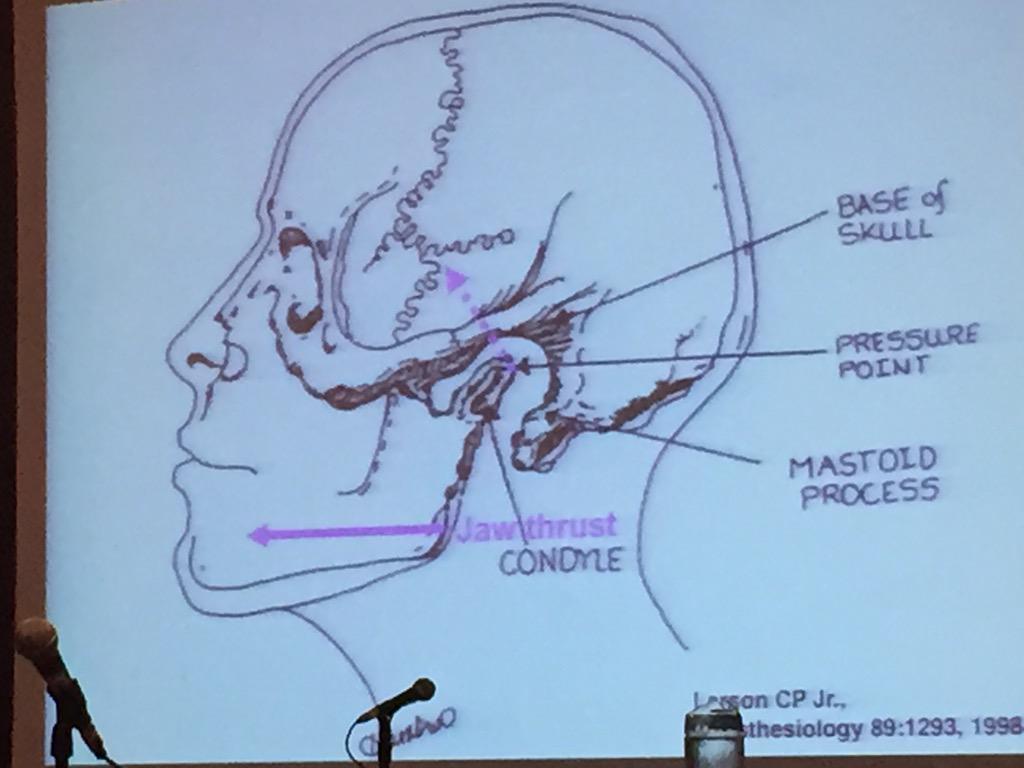 EMtogether's tweet photo. Optimize your jaw thrust.
Not at angle of jaw, but rotate TMJ.

#PSOOR #FOAMed #FOAMped http://t.co/lbJyc65RUz