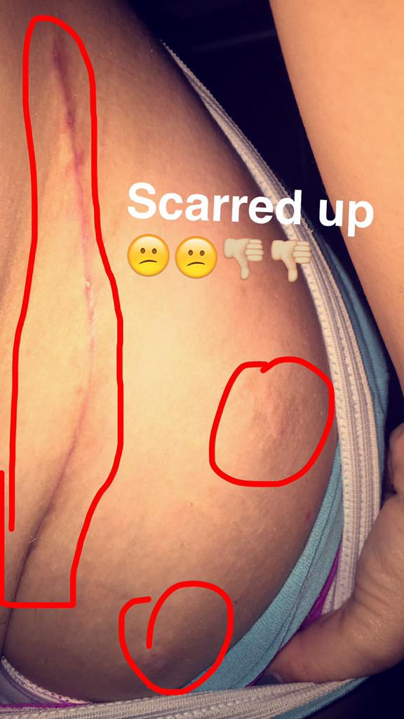 sheiebs's tweet photo. #AdultHipDysplasia is a real problem #scars #mystory #PAOSurgery #PAOWarrior #PAOTough and #FAISurgery times 2 http://t.co/lMTp9vGUUH