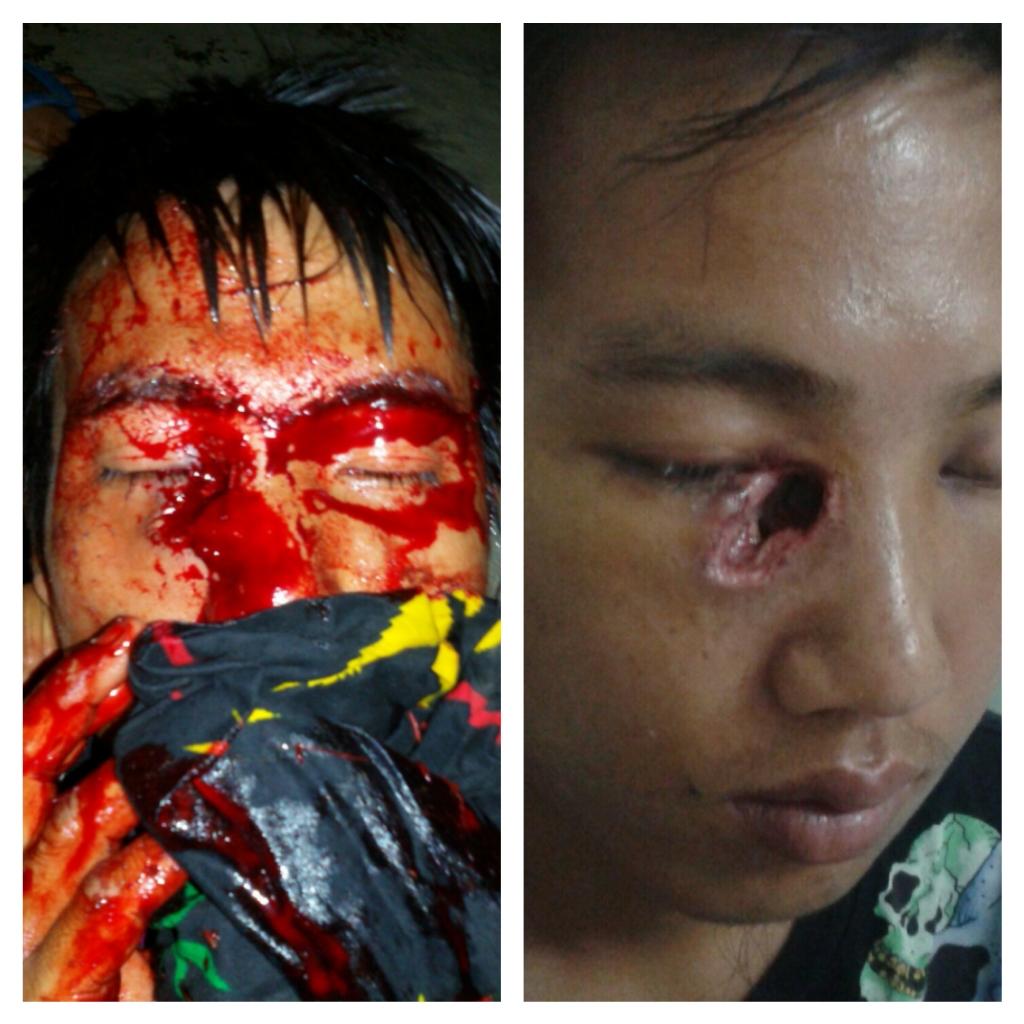 lalaguhra's tweet photo. A survivor f the #police #brutality f #manipurburning.
@ndtv @AJStream @ANI_news @thecaravanindia @NETimesmagazine http://t.co/yRs0dtluFv