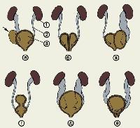 Аномалия мочевого. Аномалии мочевого пузыря. Аномалии развития мочевого пузыря. Врожденные аномалии мочевого пузыря. Полное и неполное удвоение мочевого пузыря.