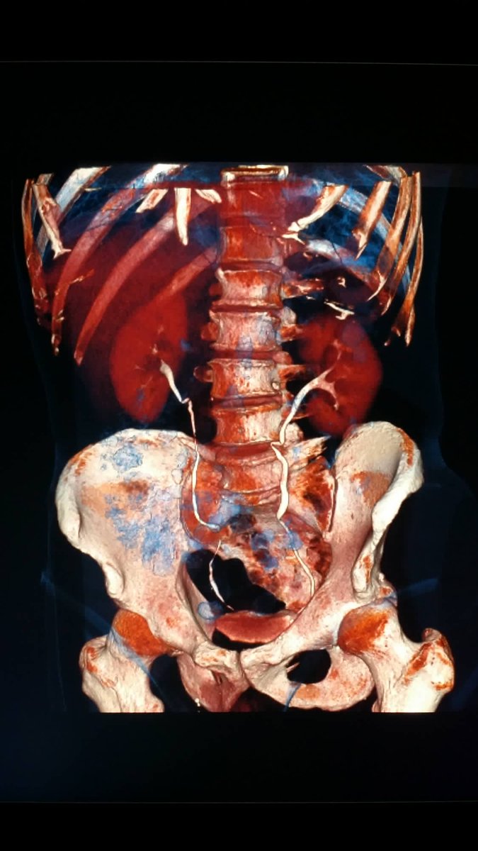 NBRadiologists's tweet photo. #Normal #Multidetector #CT of the #abdomen for a #urogram in a #patient
with #pain. #radiologist #radiology #trauma http://t.co/oRct8eGQXP