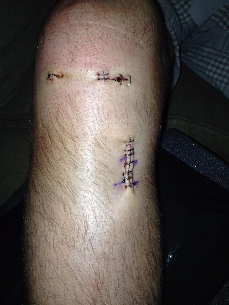 thethinhead's tweet photo. Officially 4 months since ACL surgery. Long journey but I'm not done yet! #bringonthephysio #redbullsreturn #Jan16 http://t.co/DYvJtk2b3g