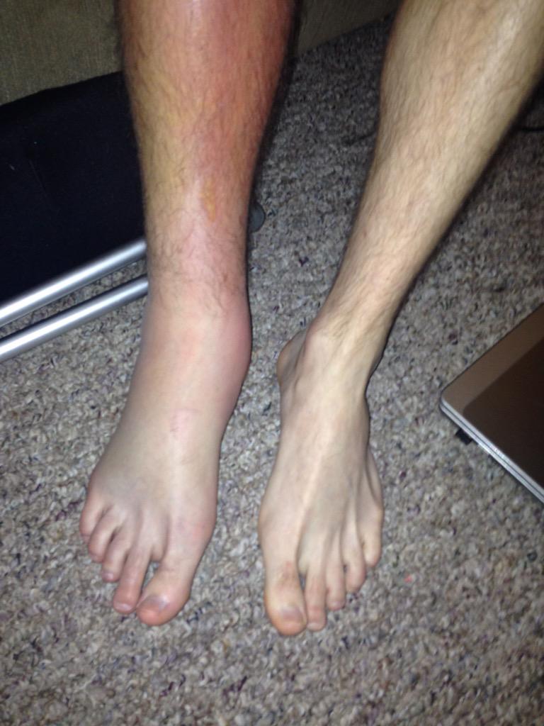 thethinhead's tweet photo. Officially 4 months since ACL surgery. Long journey but I'm not done yet! #bringonthephysio #redbullsreturn #Jan16 http://t.co/DYvJtk2b3g
