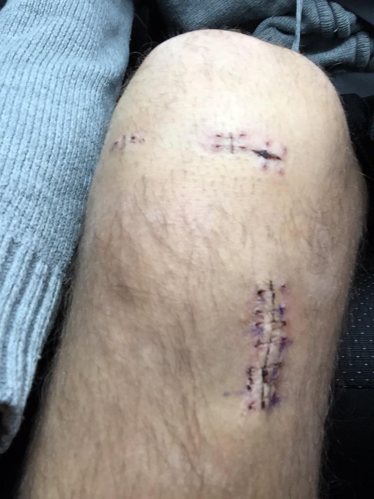 thethinhead's tweet photo. Officially 4 months since ACL surgery. Long journey but I'm not done yet! #bringonthephysio #redbullsreturn #Jan16 http://t.co/DYvJtk2b3g
