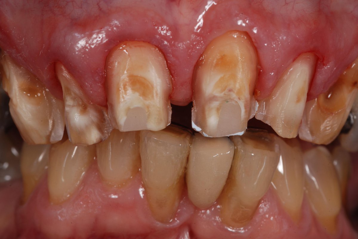 visiondentalab's tweet photo. Emax Veneers and Crowns http://t.co/W2SyJRgO8X