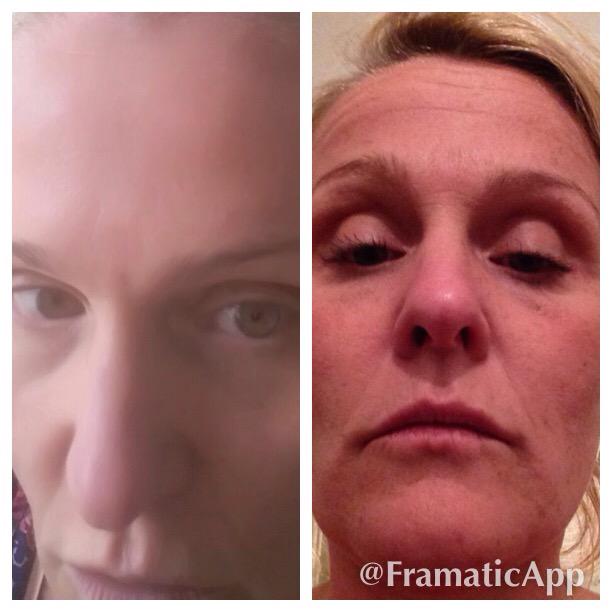 GoodbyeToBotox's tweet photo. 6 months on ... http://t.co/TCZzPGYWOw