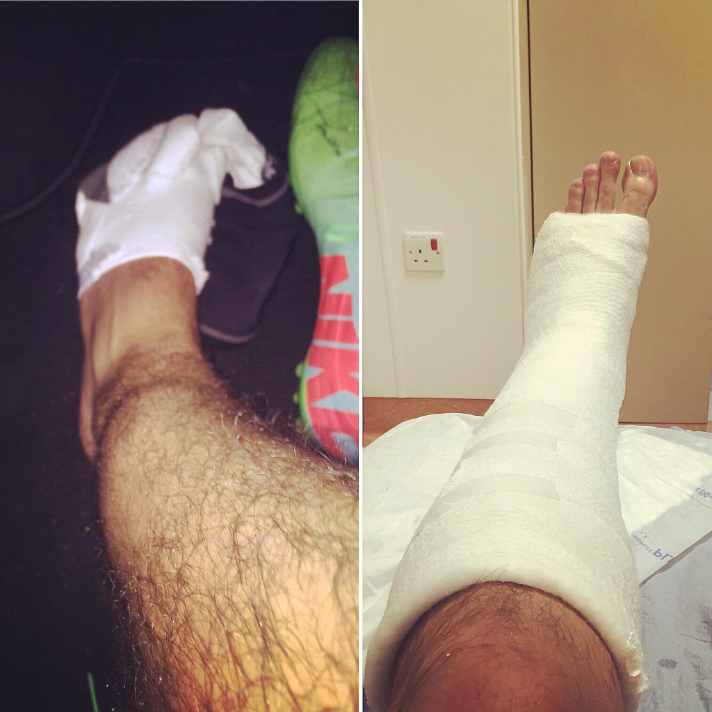 RichardNuttall2's tweet image. Absolutely gutted! Road to recovery starts now. #sadtimes #football #doublebreak  @LukeShaw23 joining the club mate!