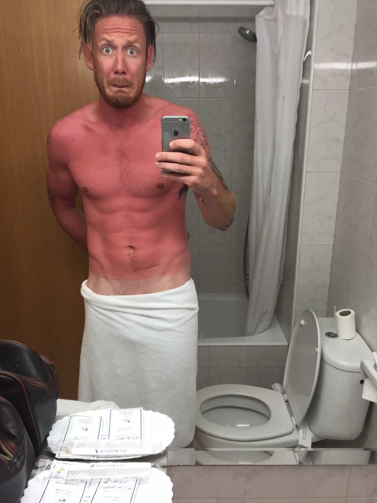 PaulBrownRWY's tweet photo. This is what happens if you fall asleep in the sun after a few beers!! #nivea #spain #ouch #sunburn #aftersunneeded http://t.co/kOzr3xnKKy